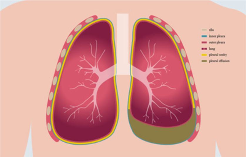 Schematic illustration of pleural effusion