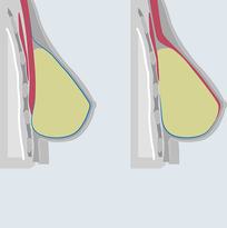 Reconstructive breast surgery