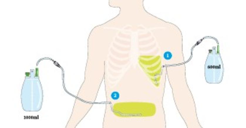 Illustration of permanent drainage catheter for pleural effusion and ascites Illustration of permanent drainage catheter for pleural effusion and ascites