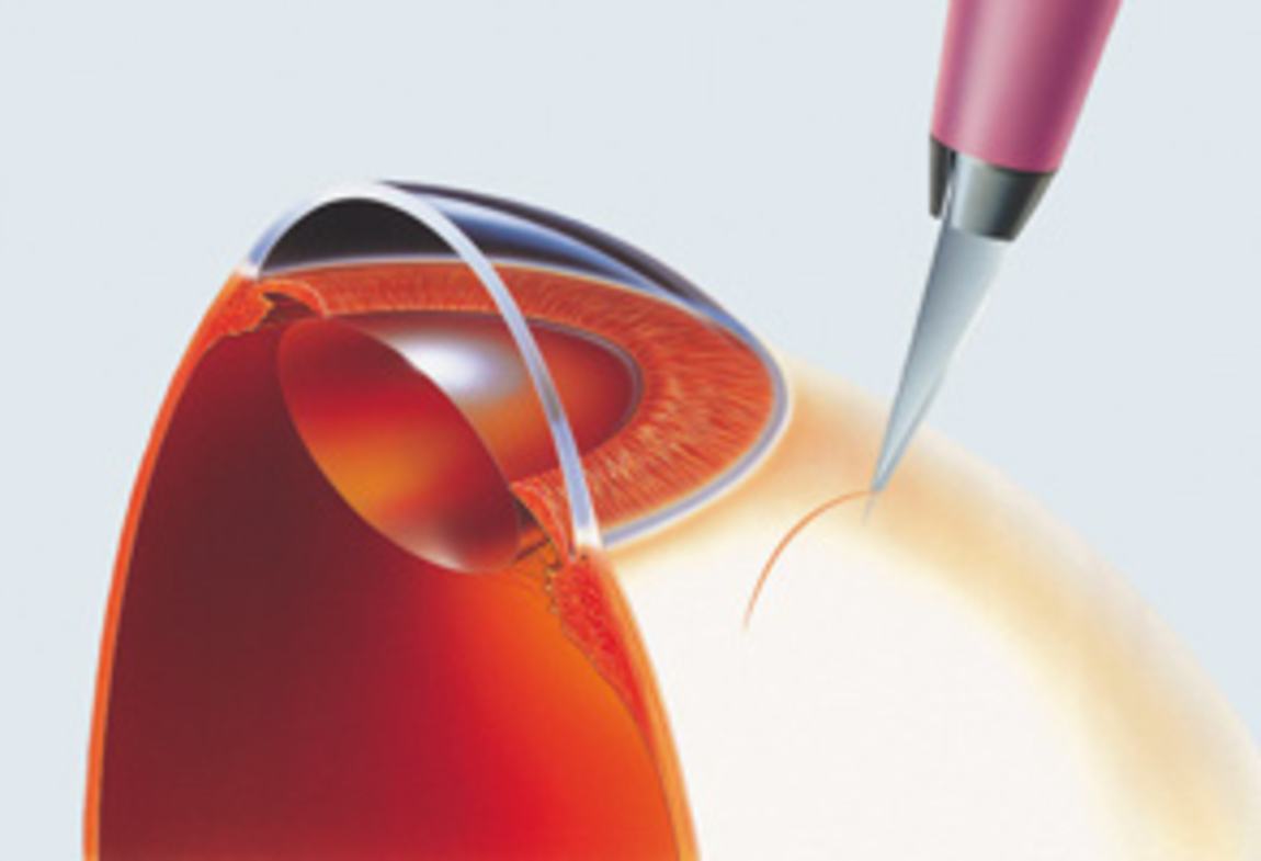 Anwendung FEATHER® Standard Inzisionsskalpell